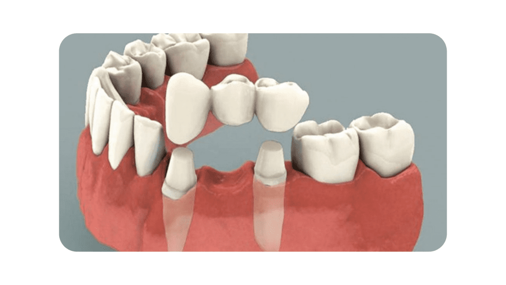 dental Bridge