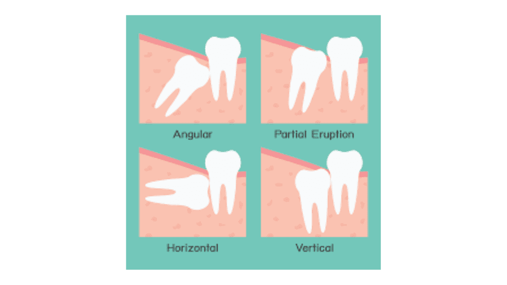 wisdom teeth