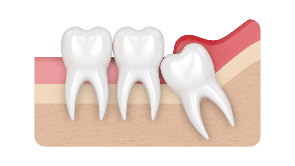 wisdom tooth