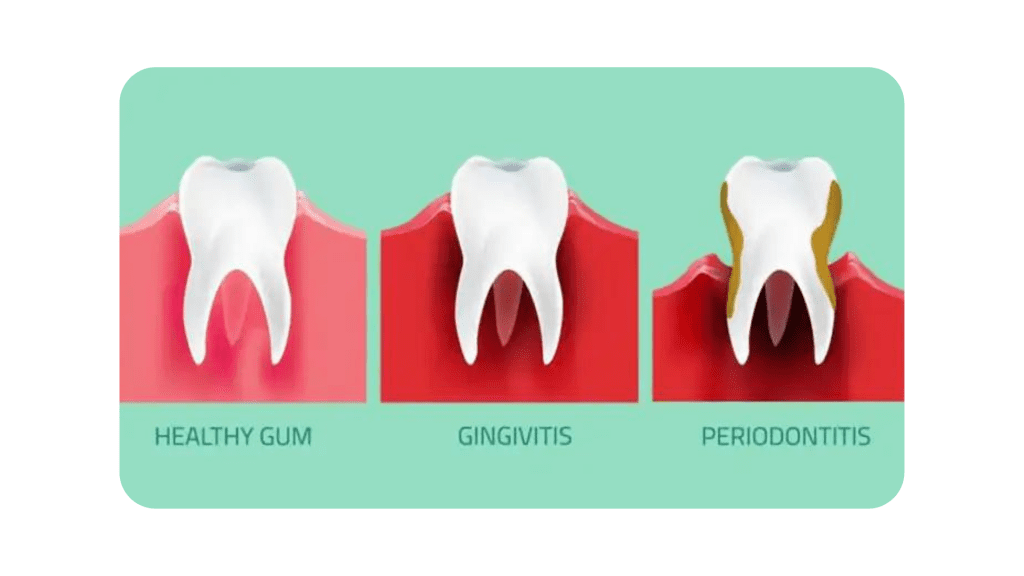 gum disease