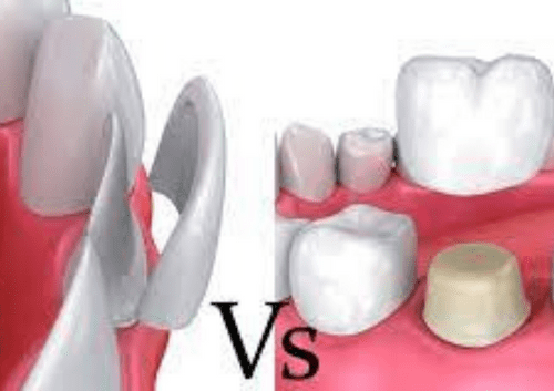 veneers vs crown