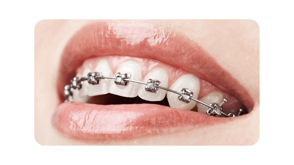 braces