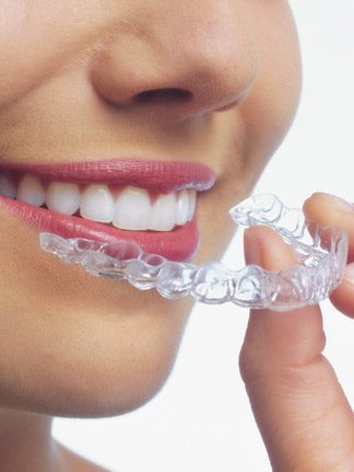 invisalign-treatment