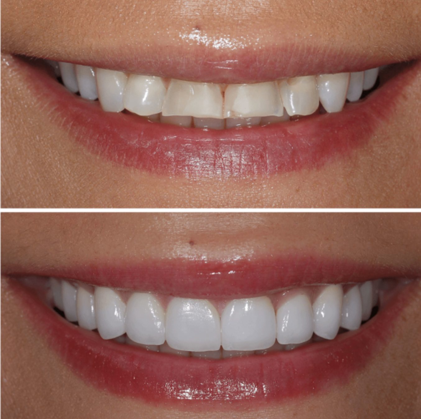 veneers
