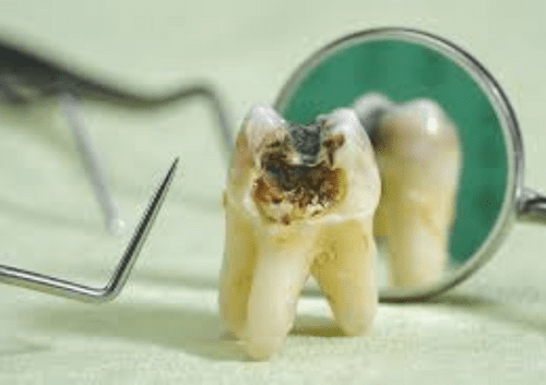 tooth decay