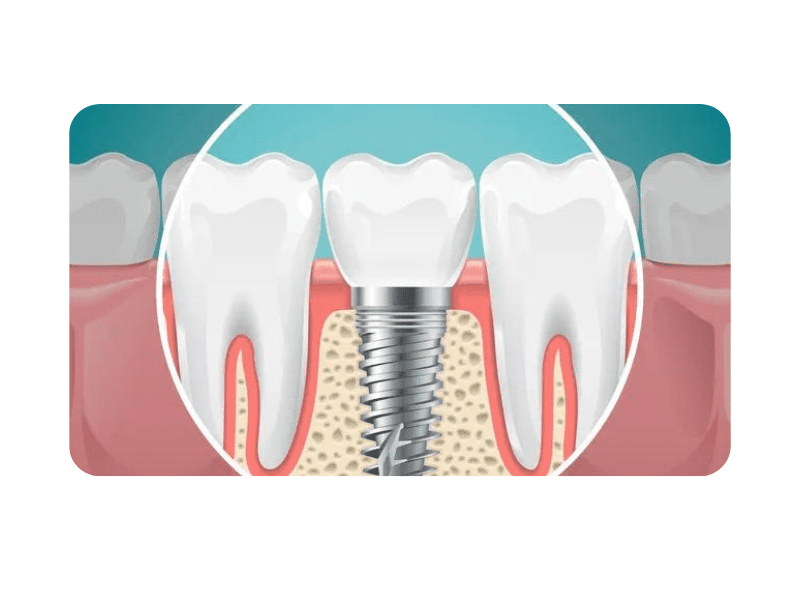 dental implants