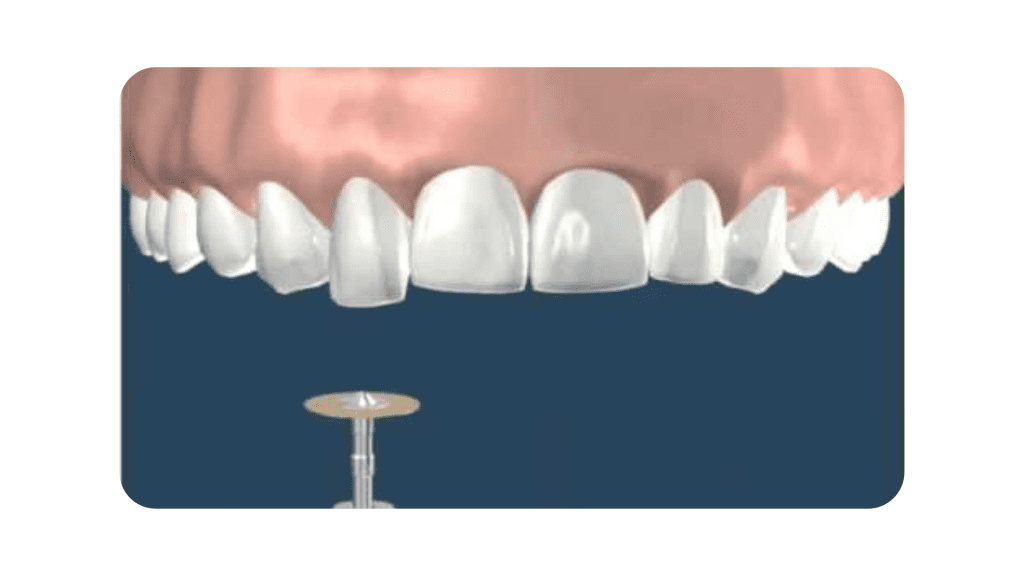 tooth recontouring