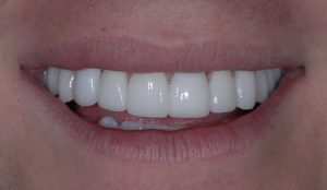 porcelain veneers after