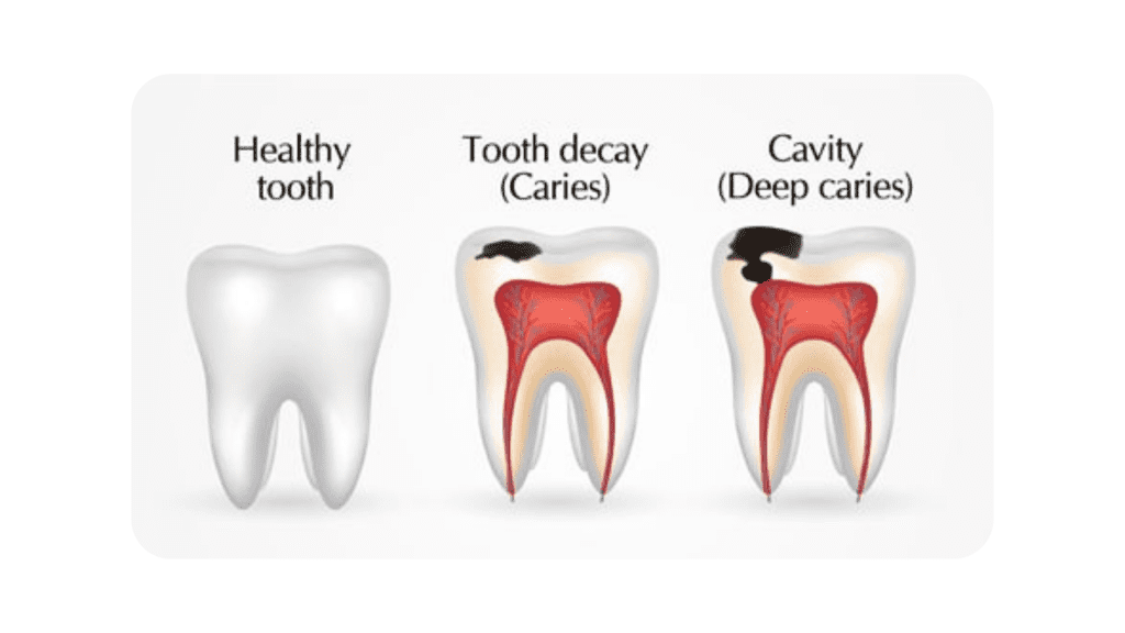 cavities