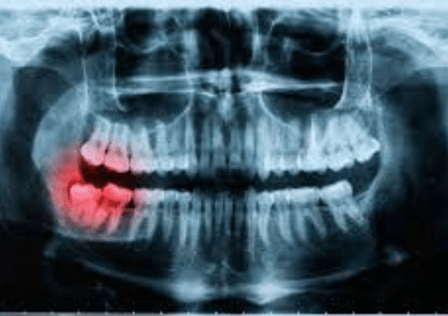 dental x-rays