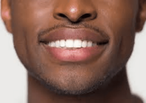 veneers