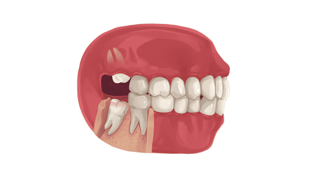 wisdom teeth