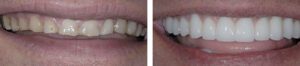 veneers