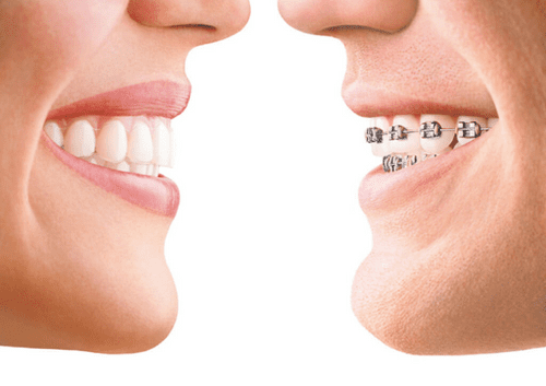 invisalign vs braces