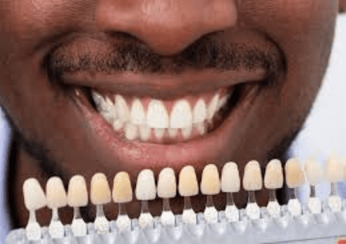 veneers