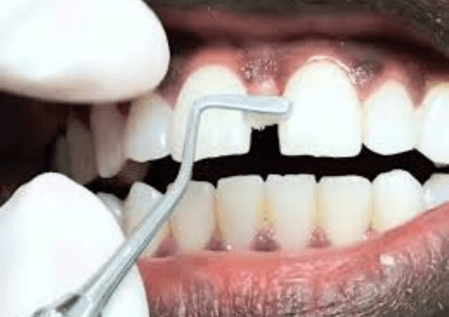gaps in teeth