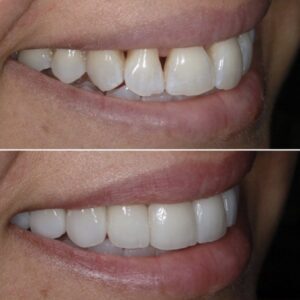 BEFORE-AFTER-CROWNS-300x300