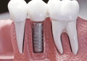 implants, dental implant
