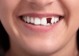 missing teeth