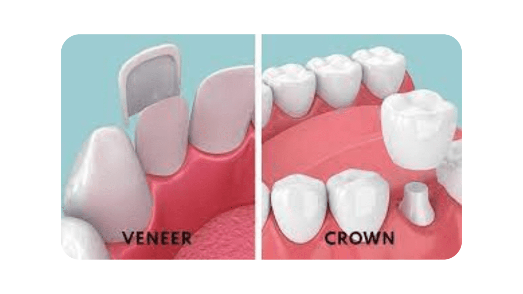 crown vs veneer