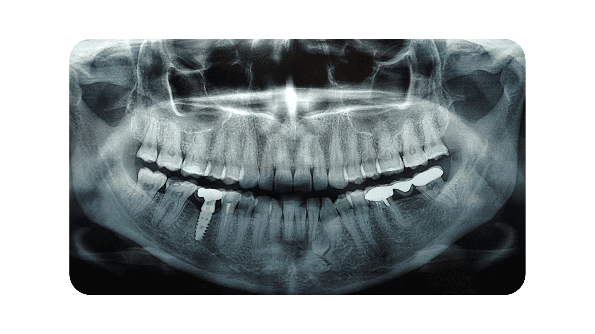Dental Radiographs In Summerlin Summerlin Dental Solutions
