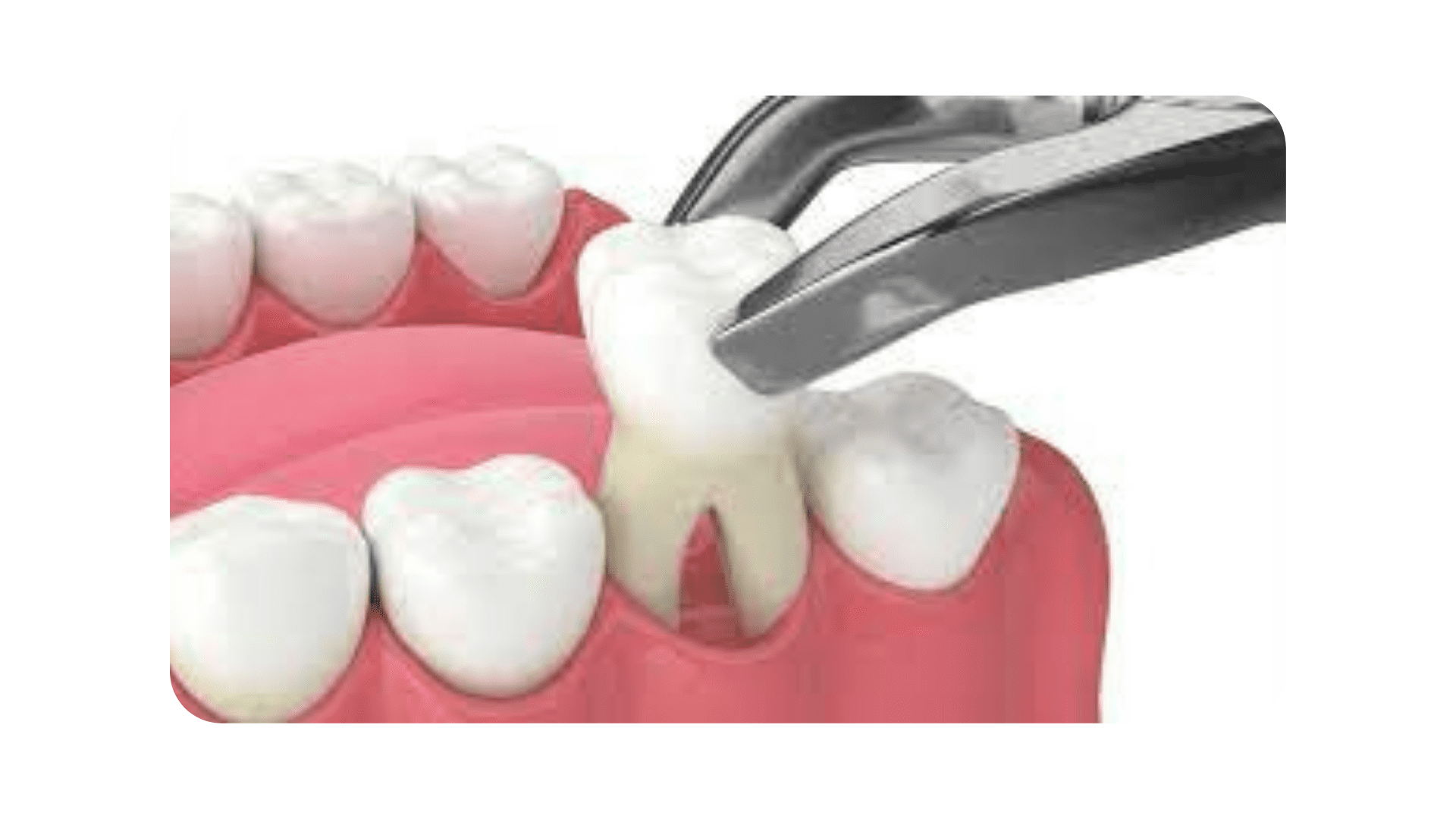 Infection Following Tooth Extraction