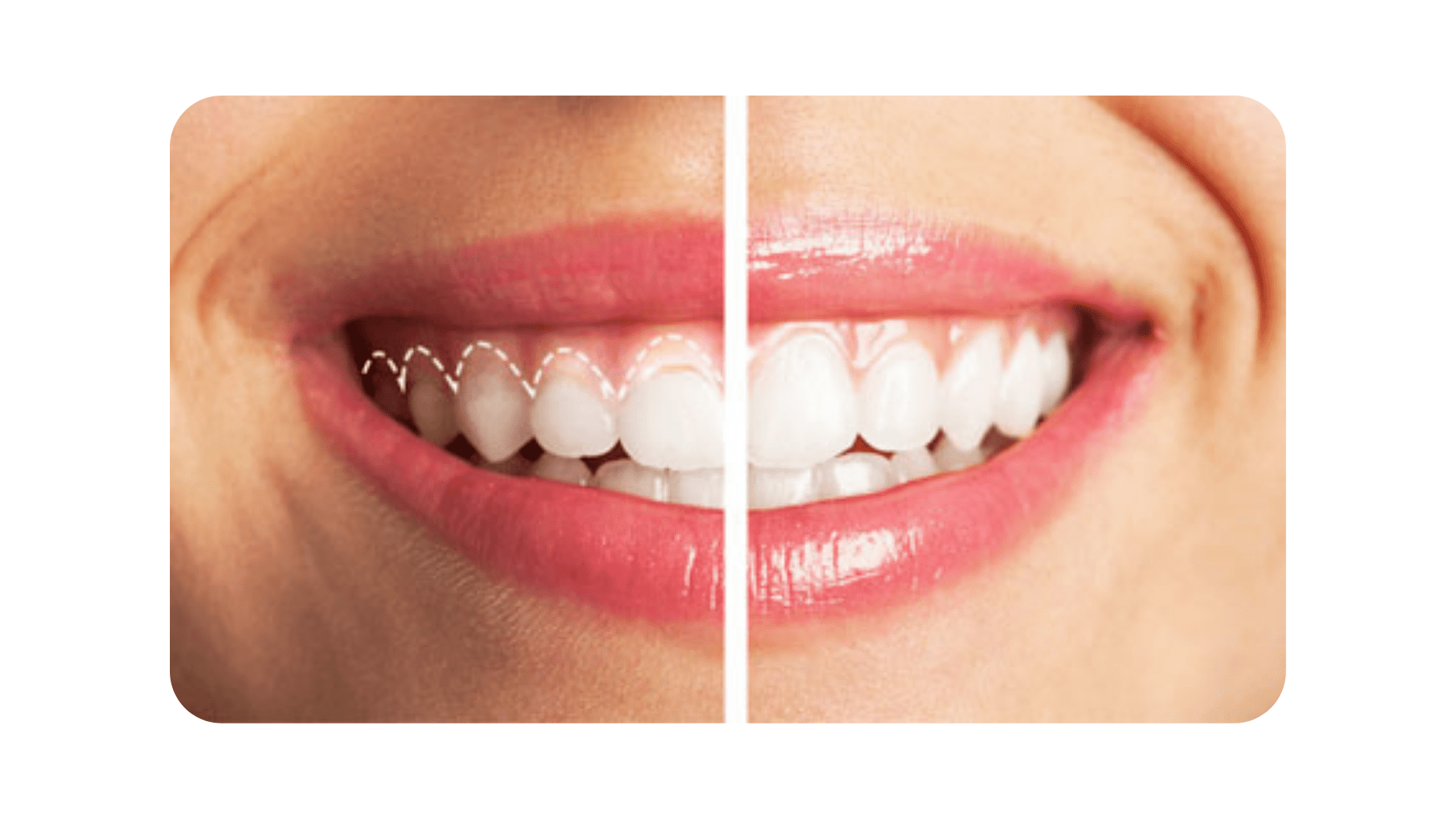 Gum Lift Options Laser Vs. Crown Lengthening In Las Vegas