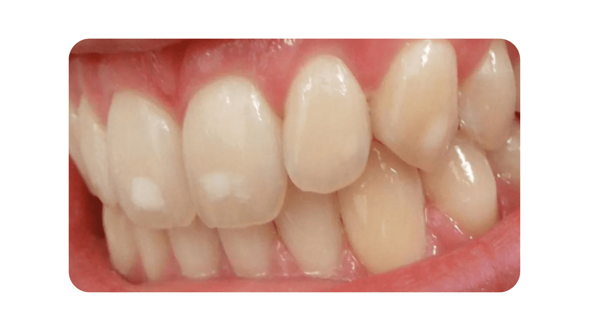 White Spots on teeth
