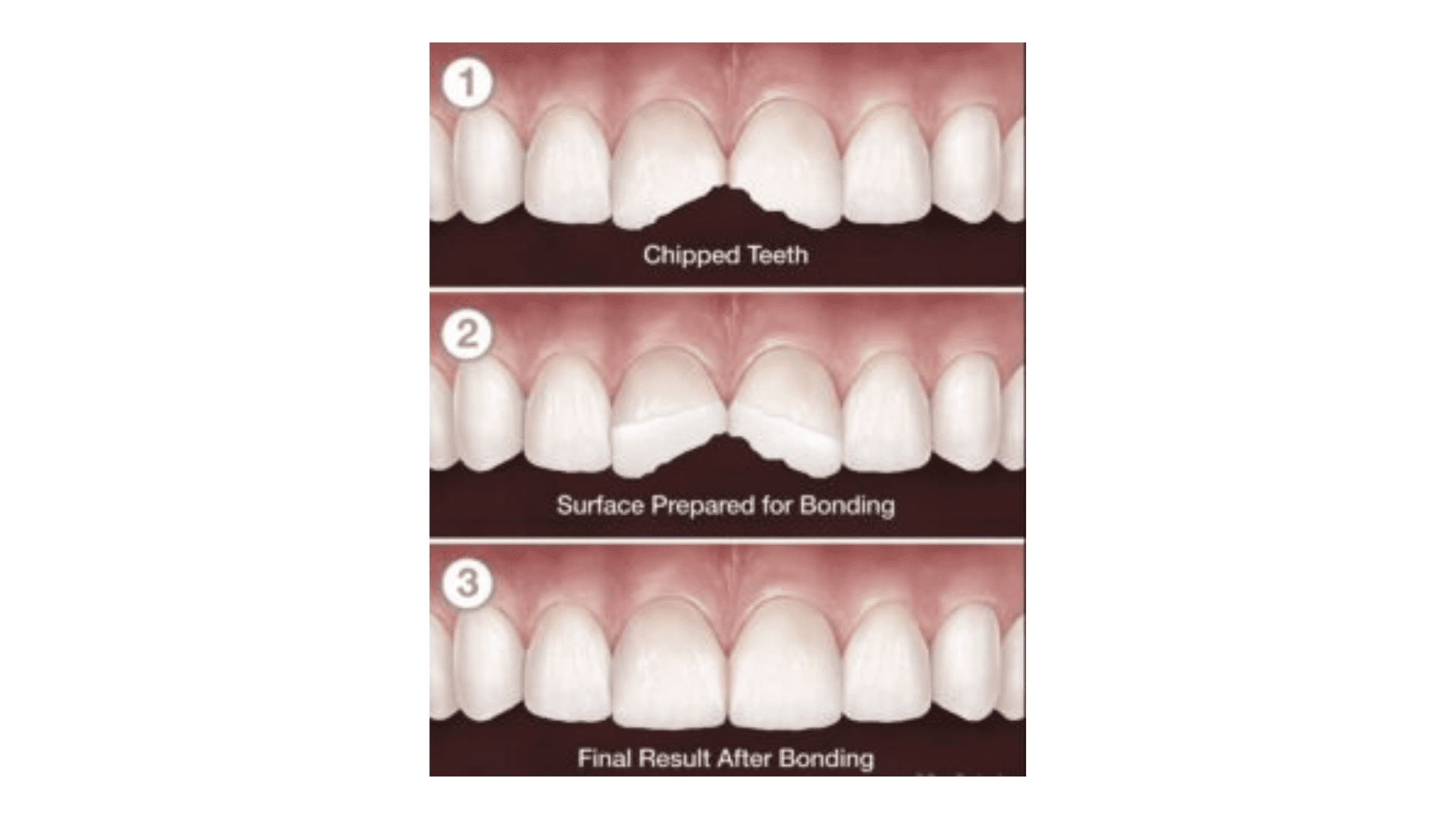 Tooth Bonding Solutions Summerlin Dental Solutions