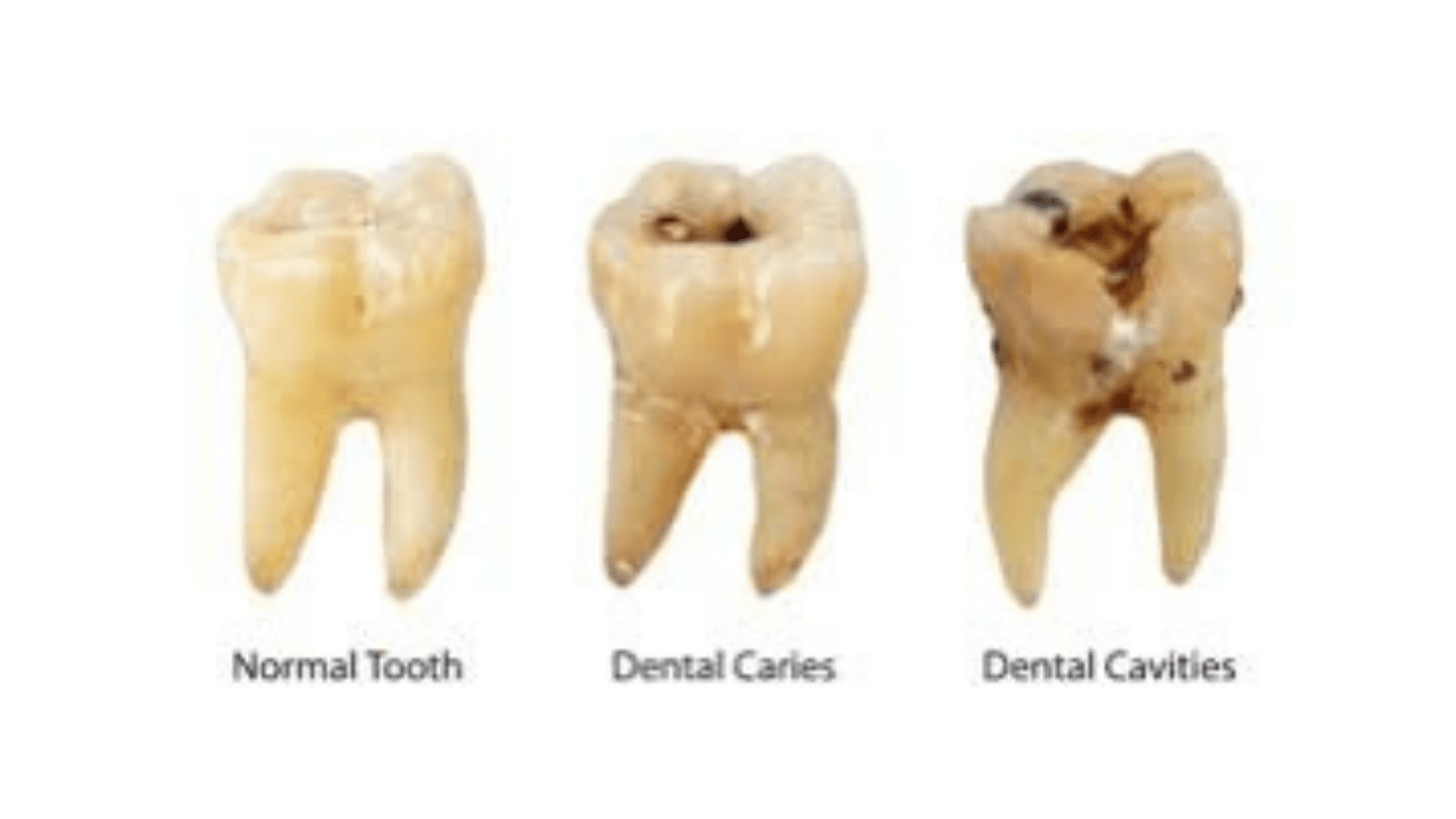 tooth decay