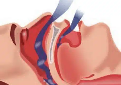 snoring and sleep apnea treated by Dr Cohan at Summerlin Dental Solutions.