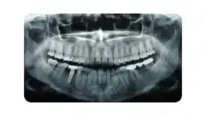 Why Dental Radiographs Are So Crucial 1 Radiographs are so crucial at summerlin dental solutions