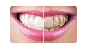 stained teeth