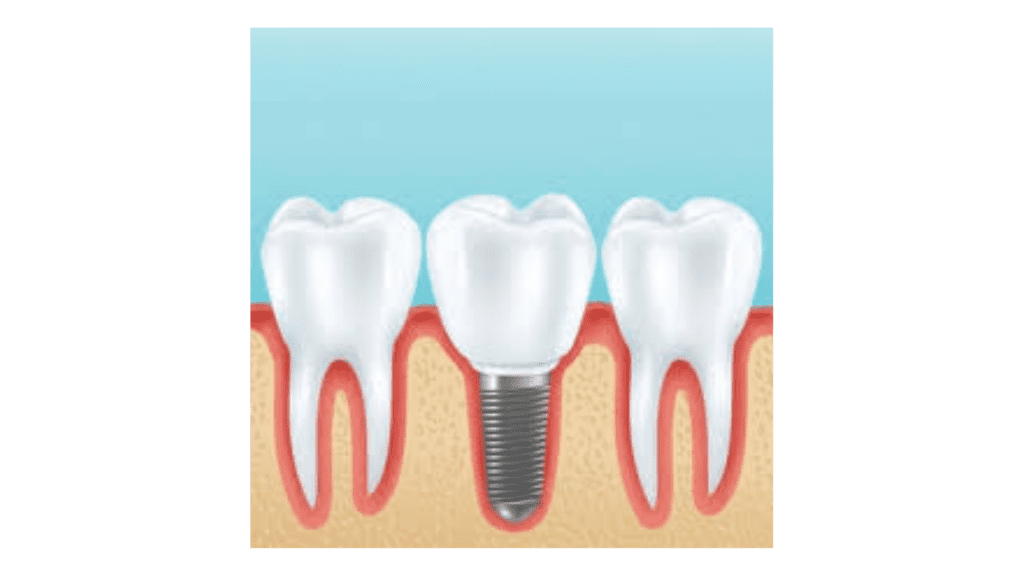 <strong>Why You Should Always Replace Missing Teeth</strong> 2