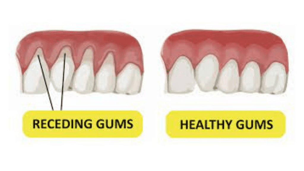 Receding gums: Causes, symptoms, & treatment 1