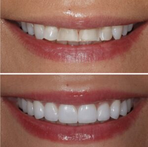  Porcelain veneers before and after smile transformation best cosmetic dentist Summerlin Las Vegas