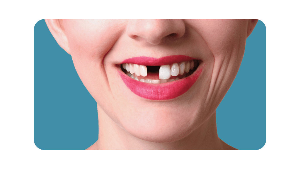 <strong>Why Replacing Your Missing Teeth Is Important</strong><strong></strong> 1