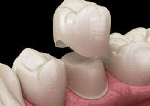 types of crowns from summerlin dental solutions