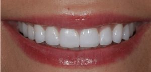 veneers