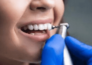 teeth cleaning at summerlin dental solutions
