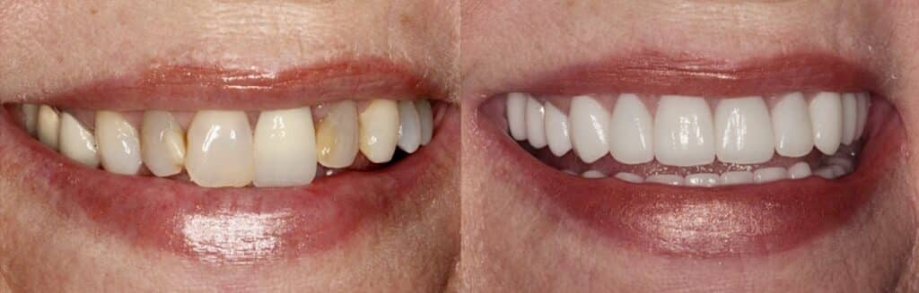 Before and after veneers smile makeover at Summerlin Dental Solutions