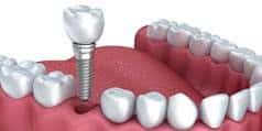 single implants are easy