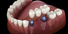 Missing teeth are no longer a problem- implant bridgr