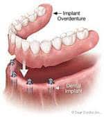 what is a all on 4 denture