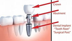 parts of a single implant