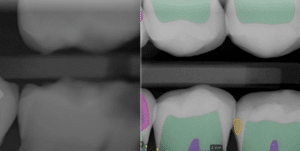 AI Dental X-ray analysis cavity detection Summerlin Dental Solutions Las Vegas