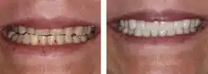 “Porcelain veneers before and after Las Vegas patient at Summerlin Dental Solutions”