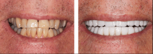 : “Smile makeover before after best dentist Summerlin Las Vegas”