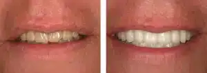 Smile makeover with porcelain veneers Summerlin Dental Solutions Las Vegas”
