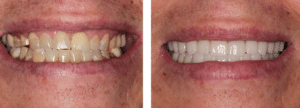 No-prep veneers close-up results Summerlin cosmetic dentist”